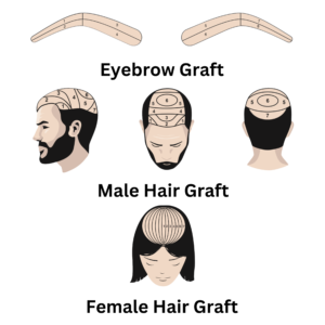 Glojas Hair Graft