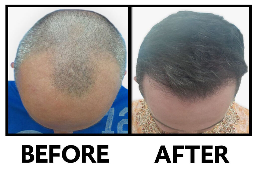 Glojas Tanam Rambut